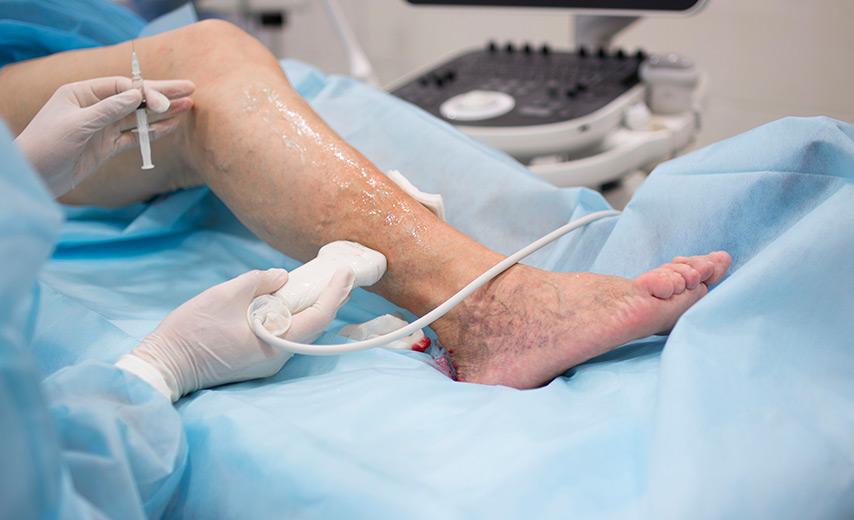 Лечение сосудистых звездочек в Киеве