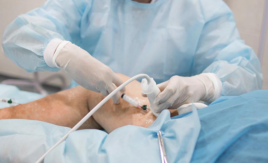 Микросклеротерапия в Киеве