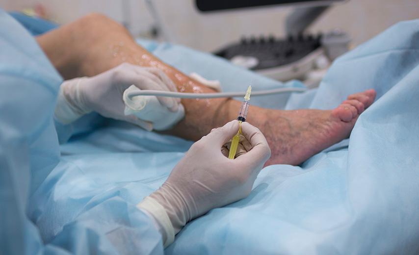 Эндовенозная лазерная коагуляция в Киеве